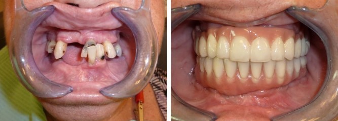  Имплантация зубов за один день